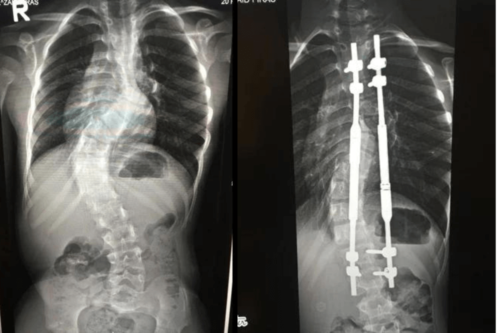 Scoliosis/Kyphosis