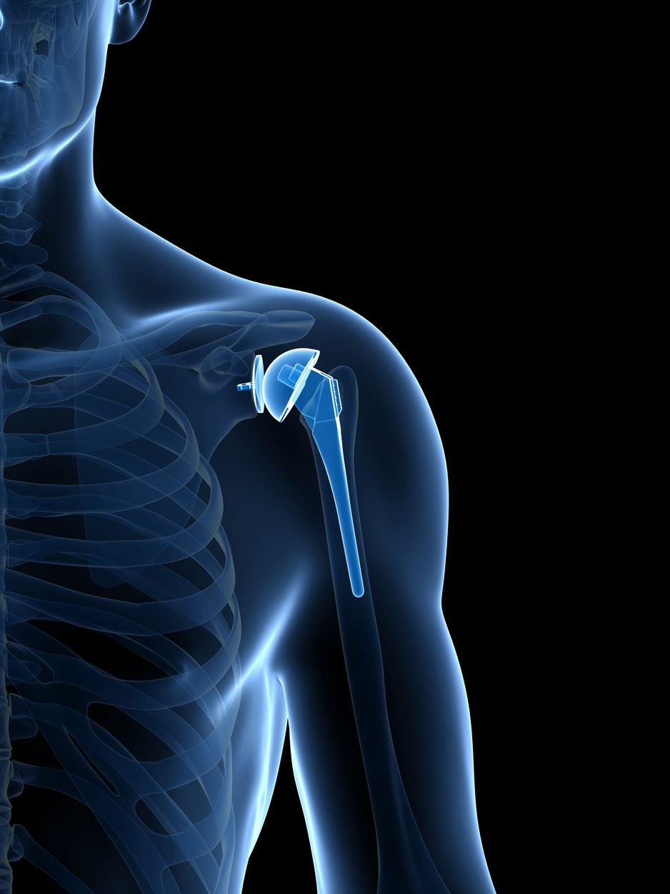 shoulder replacement infographic