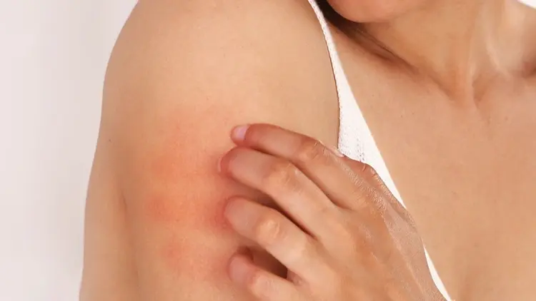 Skin Allergy Testing Dubai