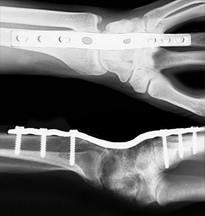 Partial and Total Wrist Fusion