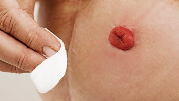 Stoma