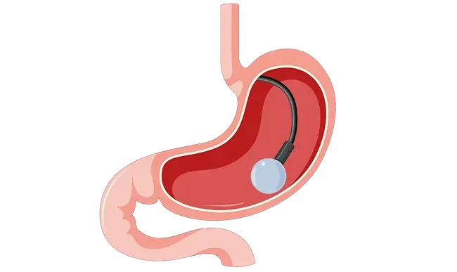 Swallowable Gastric Balloon vs Endoscopic Gastric Balloon: What Is the Difference?