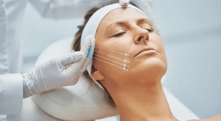 Non-Surgical Face Lift / Thread Lift in Dubai