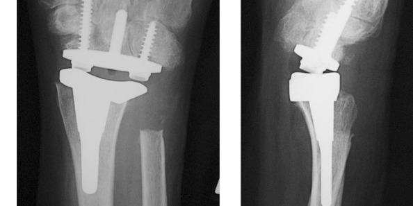 total wrist replacement-1