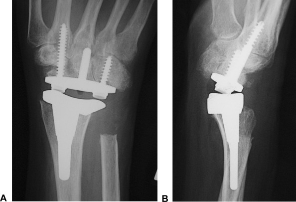 total wrist replacement