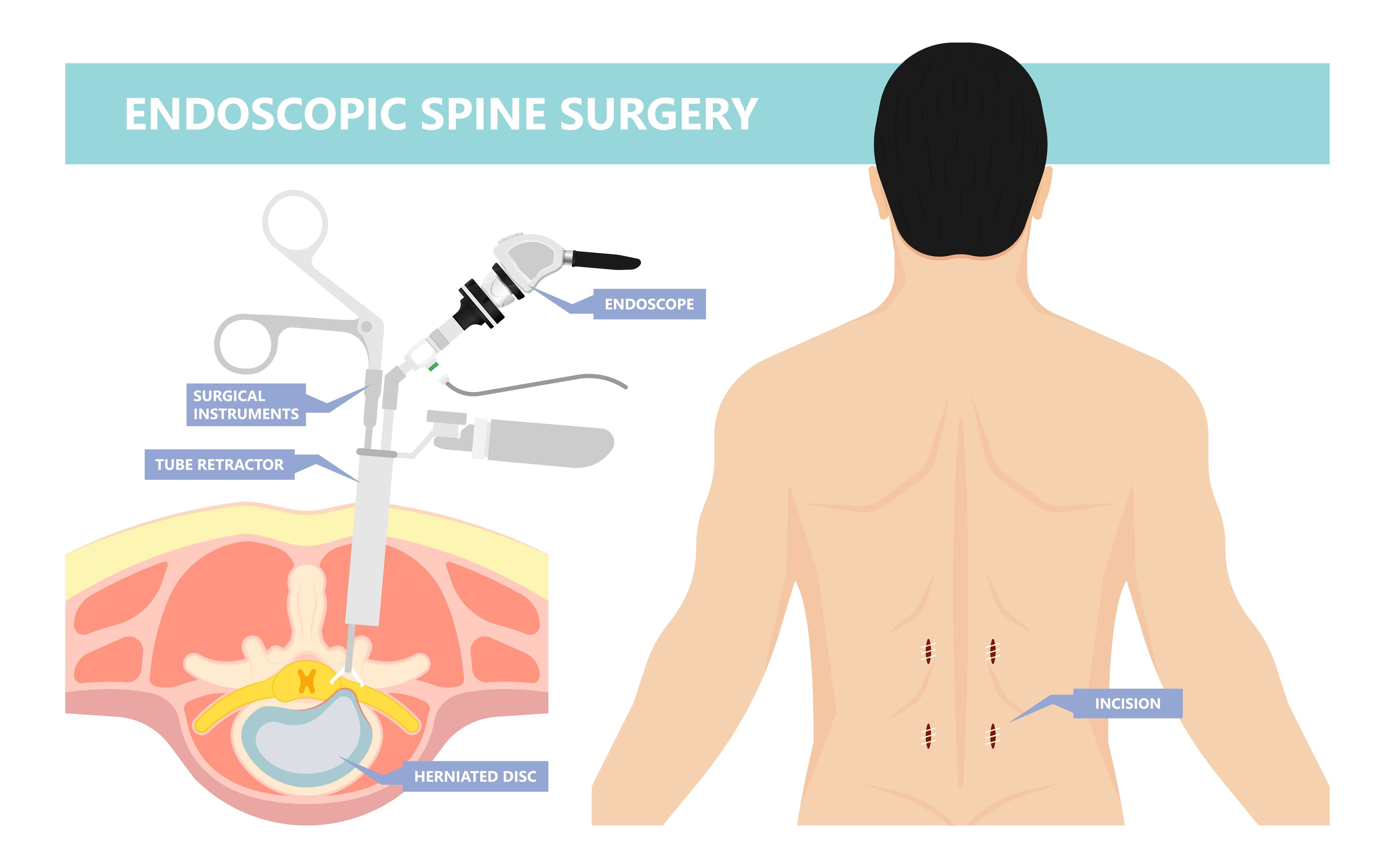 Types of Full Endoscopic discectomy